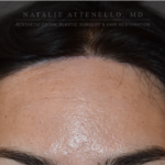 forehead reduction surgery cost