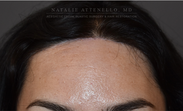 forehead reduction surgery cost